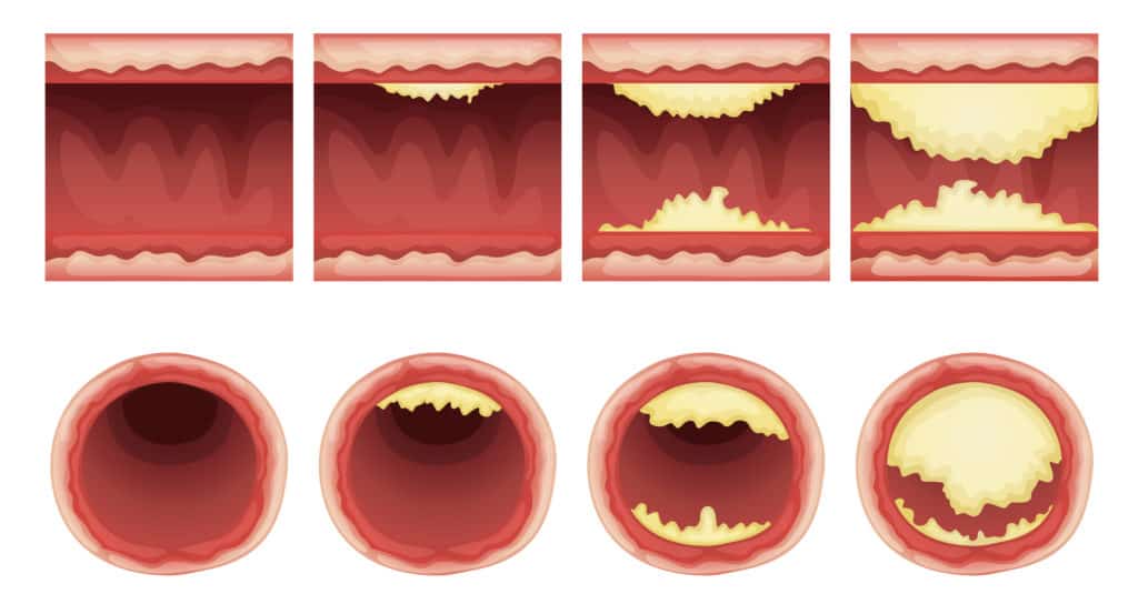 Acumulaciones de placas vasos sanguíneos colesterol arteriosclerosis